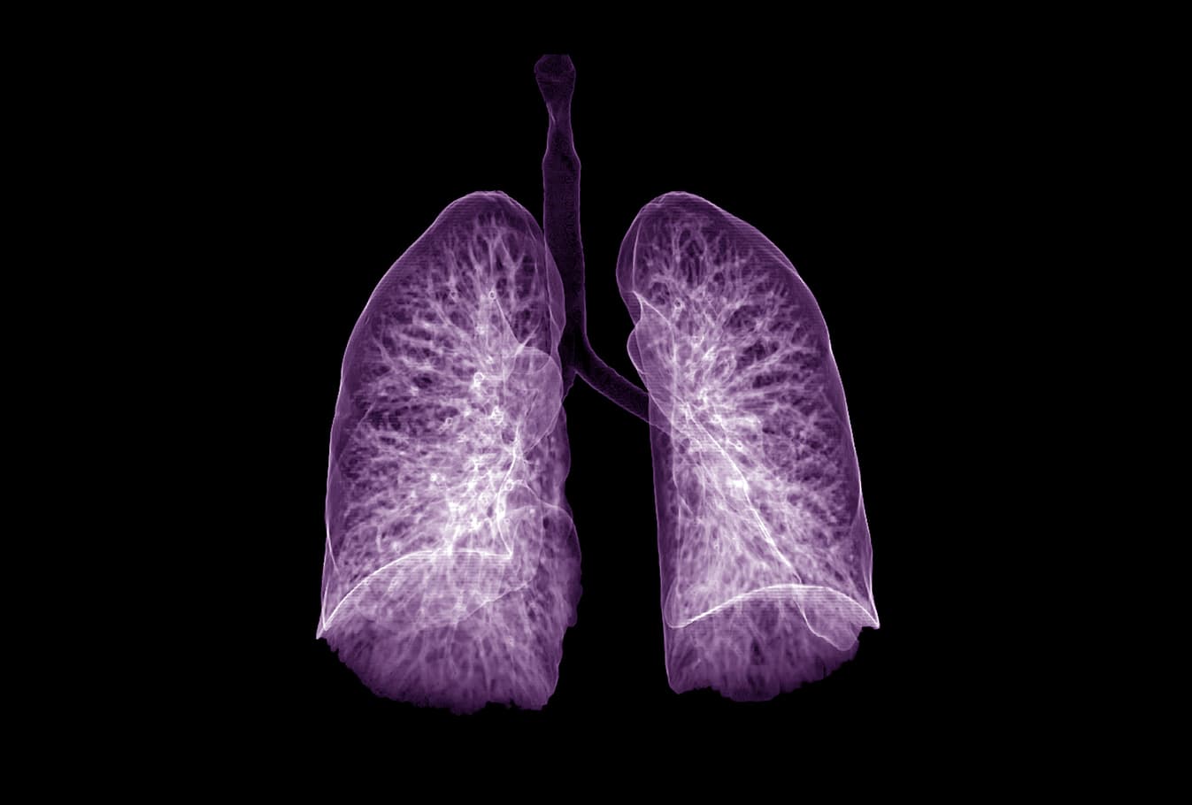 Tuberculosis program lungs diagnostic visual
